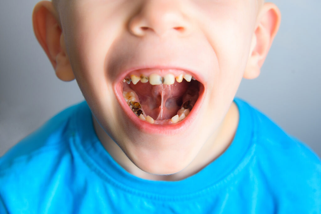 Что делать, если у ребенка болит молочный зуб?